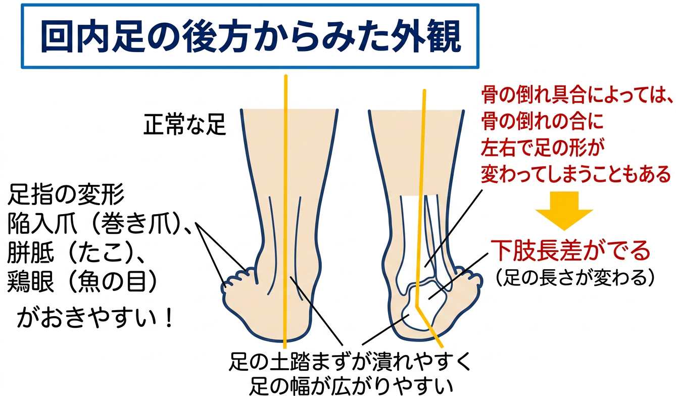 足の歪み、揉むだけでは治らない理由